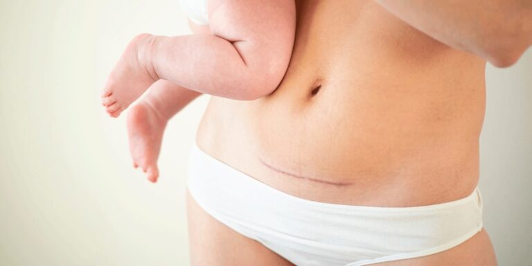 É possível ter parto normal após cesárea?