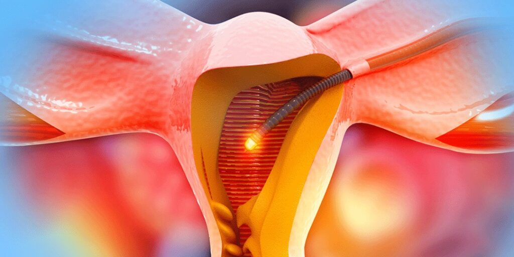 Saiba onde realizar histerectomia em Florianópolis