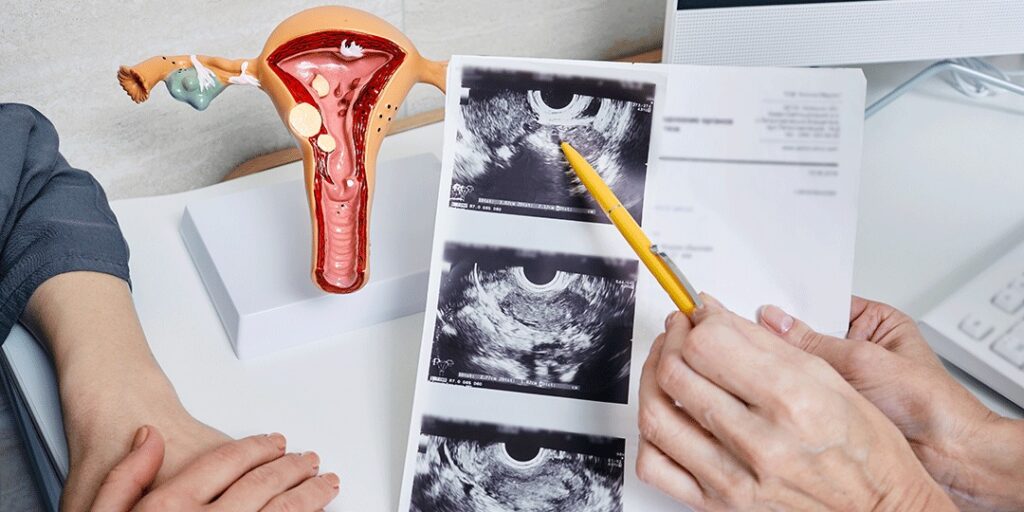 É possível prevenir doenças nos ovários e útero?