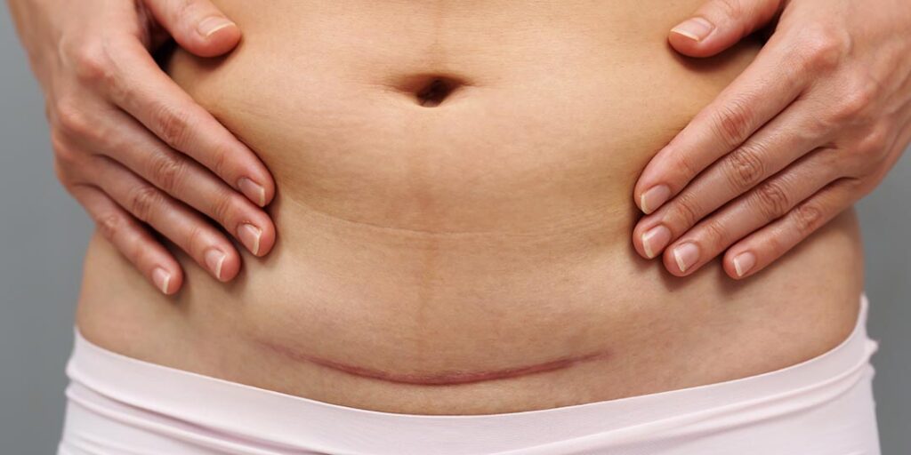 Conheça os principais mitos e verdades sobre a cesárea