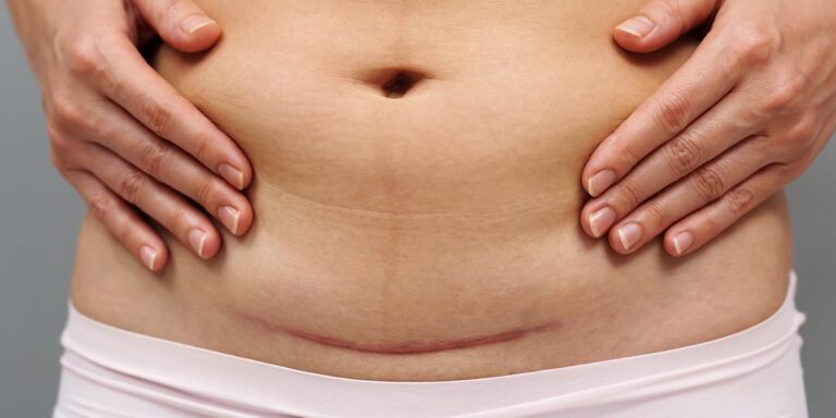 Conheça os principais mitos e verdades sobre a cesárea